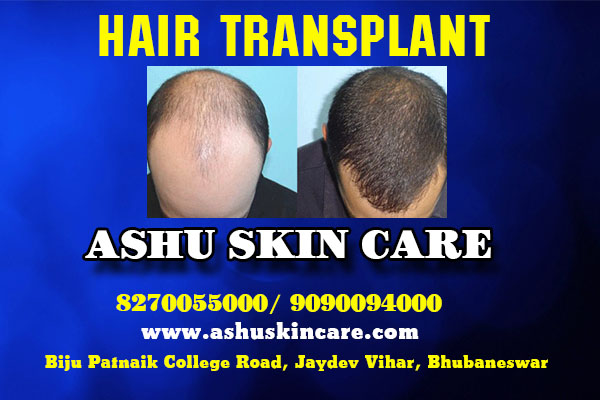 best hair transplant clinic in bhubaneswar near by ayush hospital